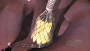 Navigating The Intricacies Of Medical Narration: From Corporate Videos To Patient Education | D.c. Douglas Illustration of a surgical tool with a netted end used in a medical procedure.